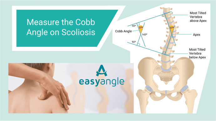 Cobb angle and Spinal Range of Motion Assessment and Scoliosis with EasyAngle